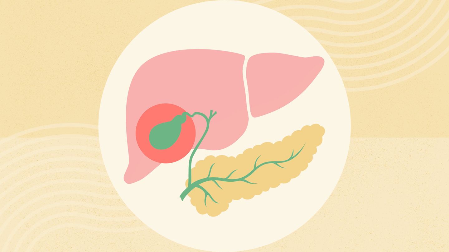 inflammation of the gallbladder without gallstones