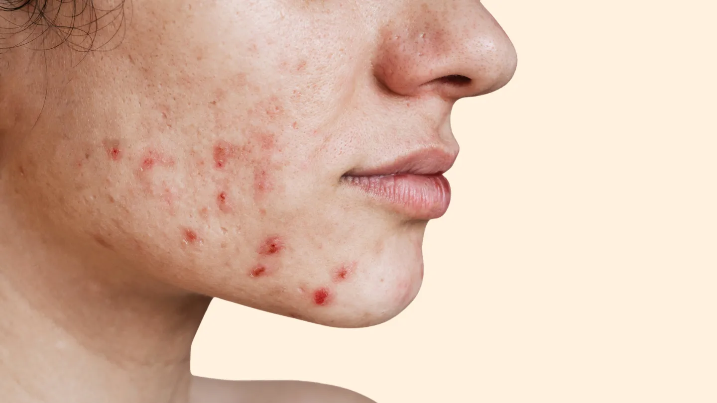 woman with face acne