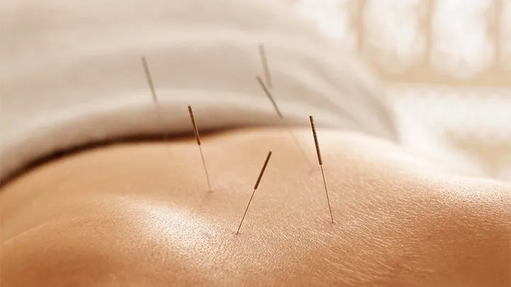 acupuncture needles in a person's back, for sexual health