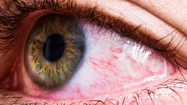 Allergy-Relief-Soothing-Swollen-Eyes red itchy allergies spring