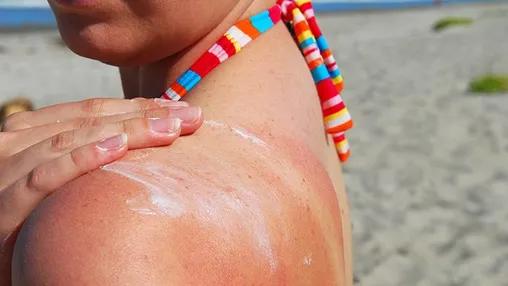 How to Identify, Prevent, and Treat a Sunscreen Allergy