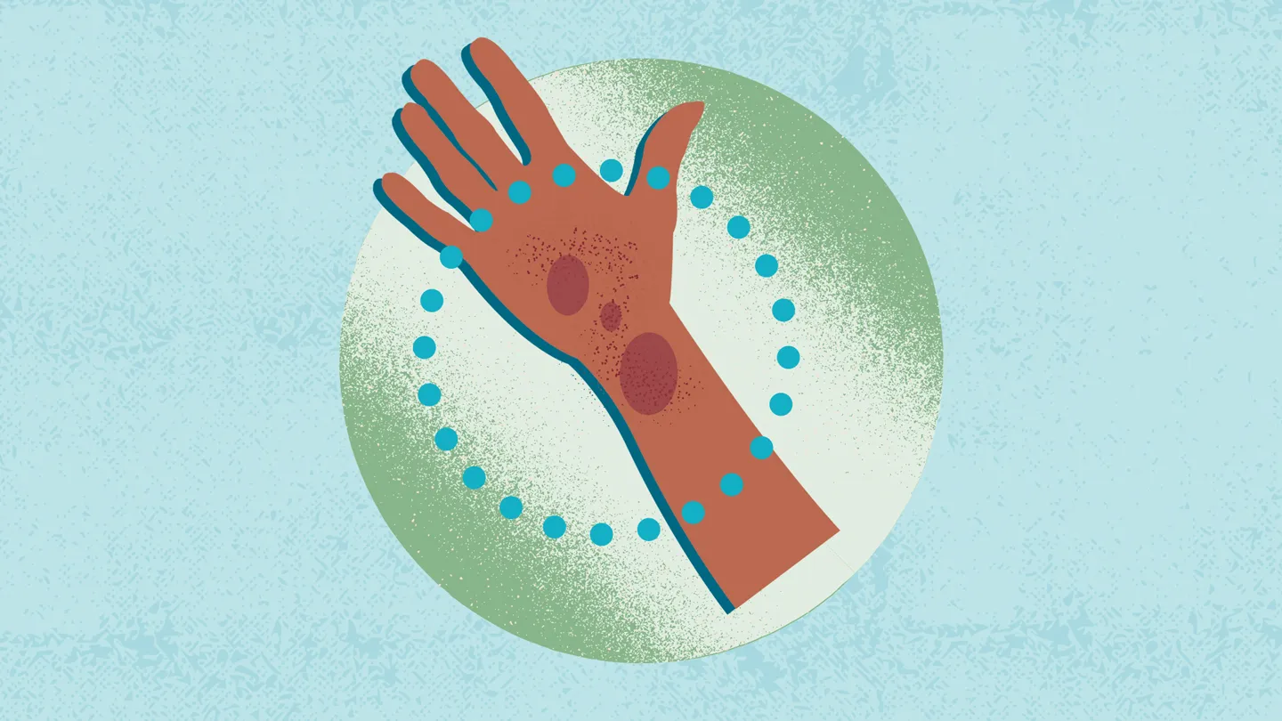 illustration of a Black hand with a rash
