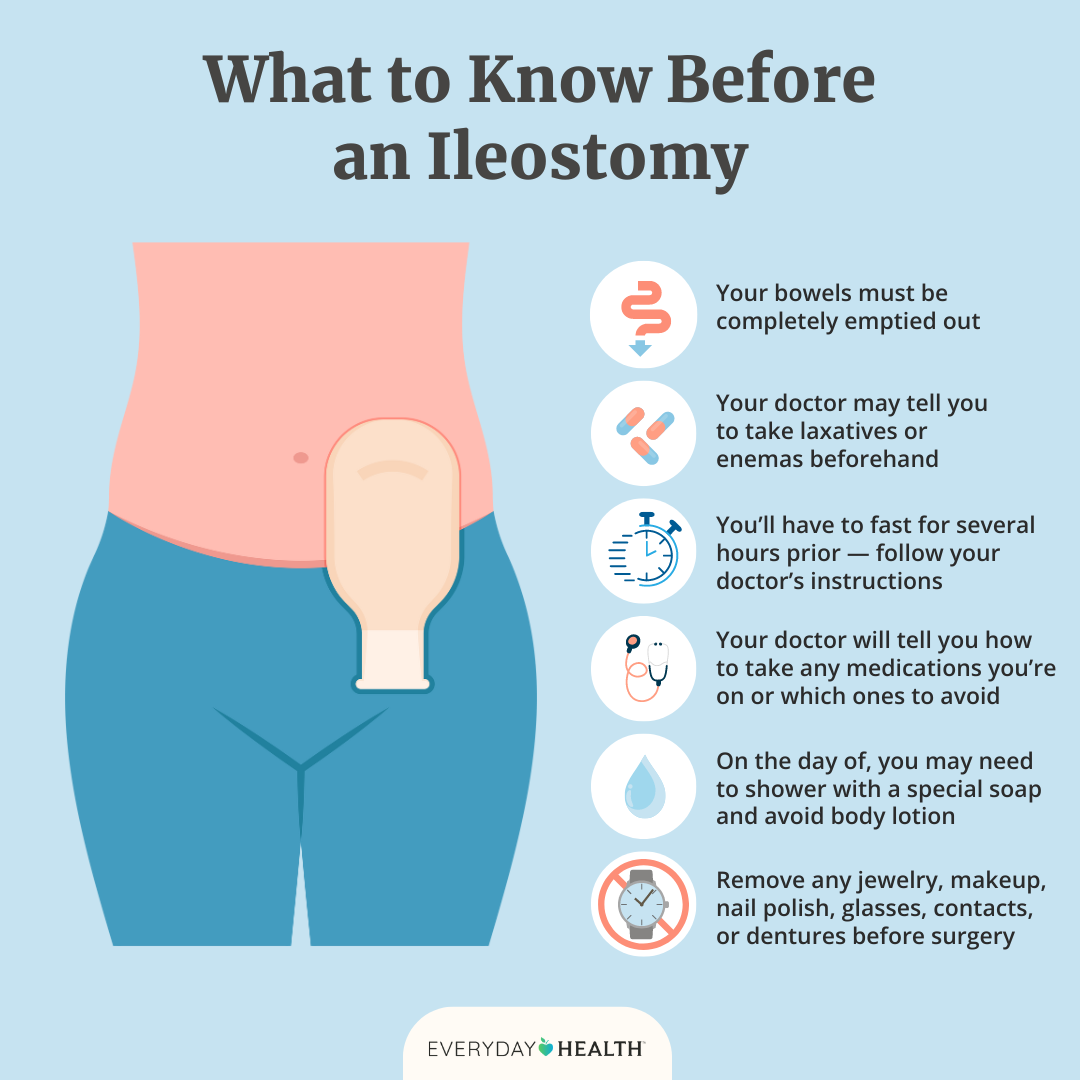 Illustrative graphic titled What to Know Before an Ileostomy shows Your bowels must be completely emptied out, Your doctor may tell you to take laxatives or enemas beforehand, You’ll have to fast for several hours prior — follow your doctor’s instructions