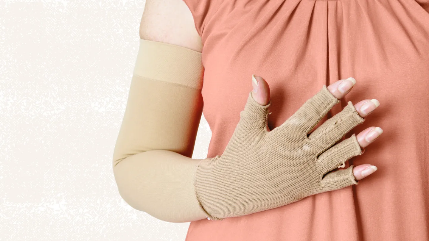 Compression garments on the hands and arms of a woman who has Lymphedema also known as Lymphatic obstruction.