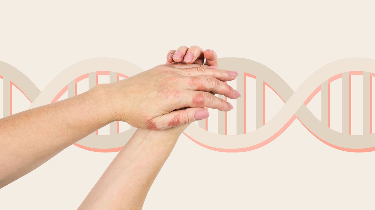 hands with eczema dna genes