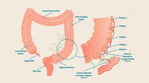Colon Cancer Stages: What Do They Mean?