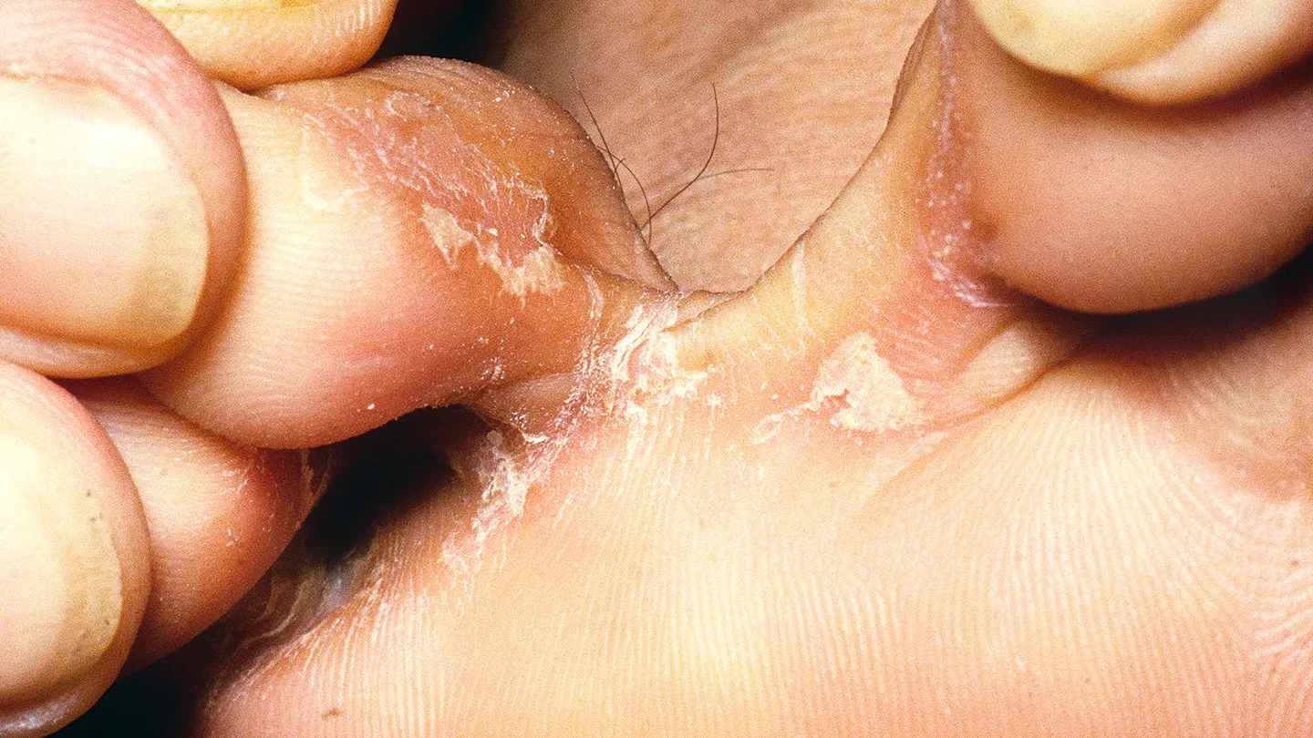 Common-Foot-Problems-01-Athletes-Foot-RM-1440x810
