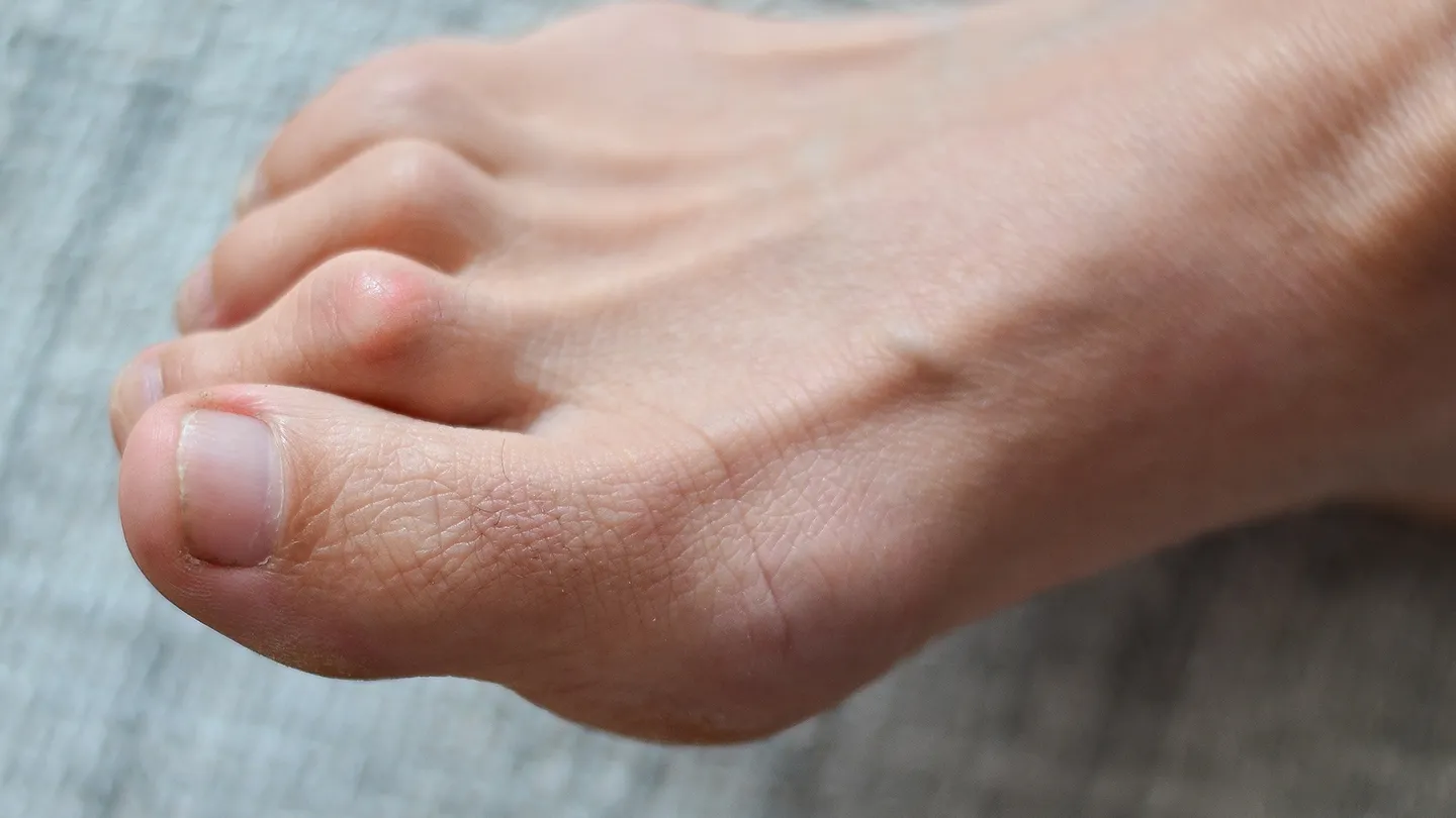 Common-Foot-Problems-02-hammertoes-1440x810
