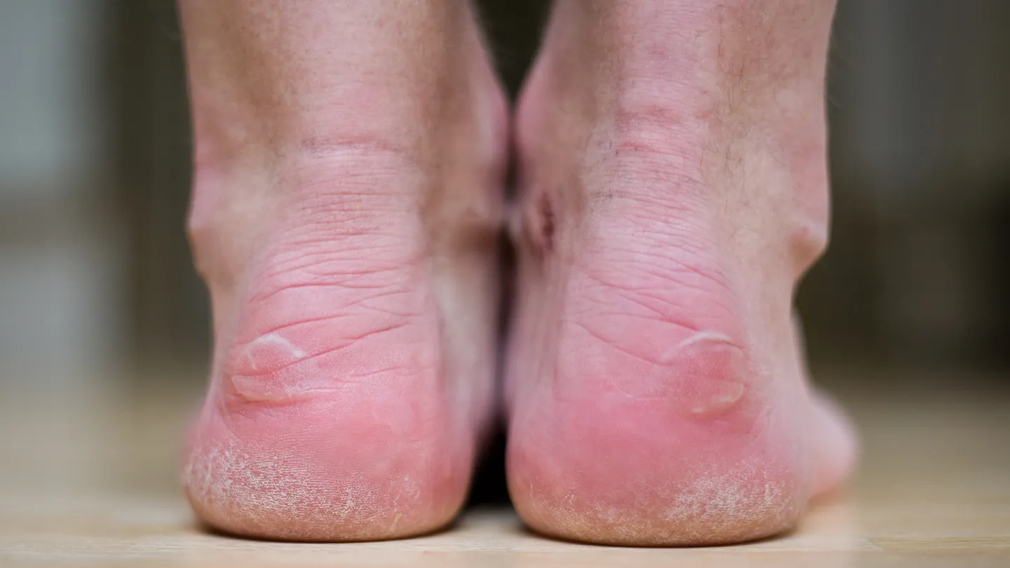 Common-Foot-Problems-03-blisters-1440x810