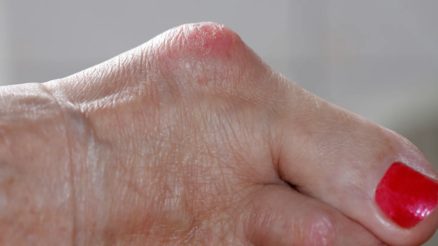 Common-Foot-Problems-04-bunions-RM-1440x810