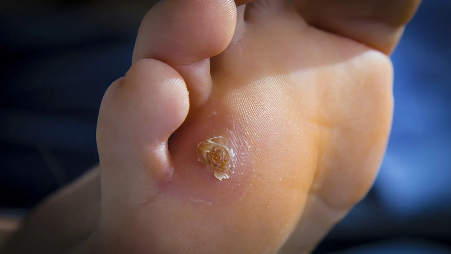 Common-Foot-Problems-05-corns-and-calluses-1440x810