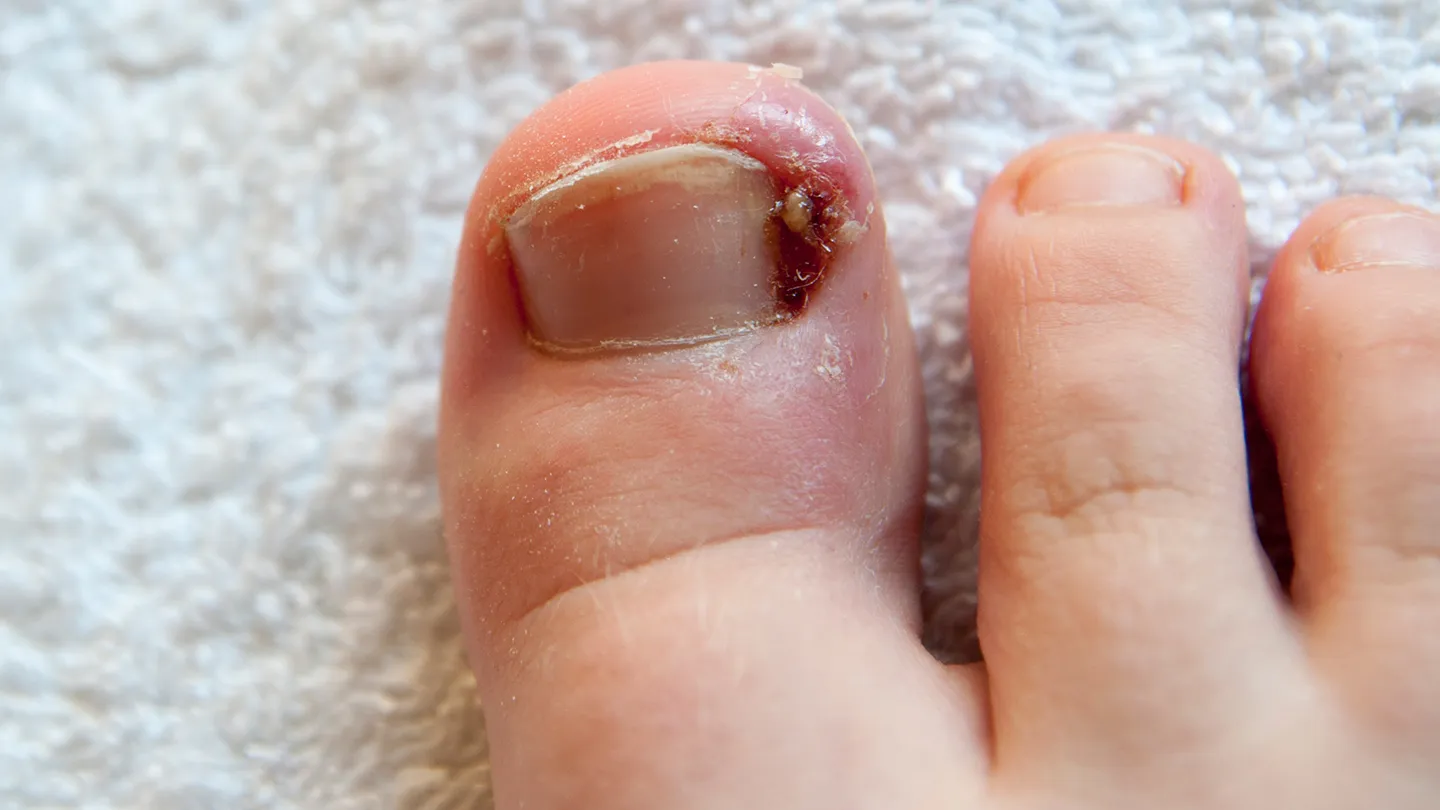 Common-Foot-Problems-09-ingrown-toenails-1440x810