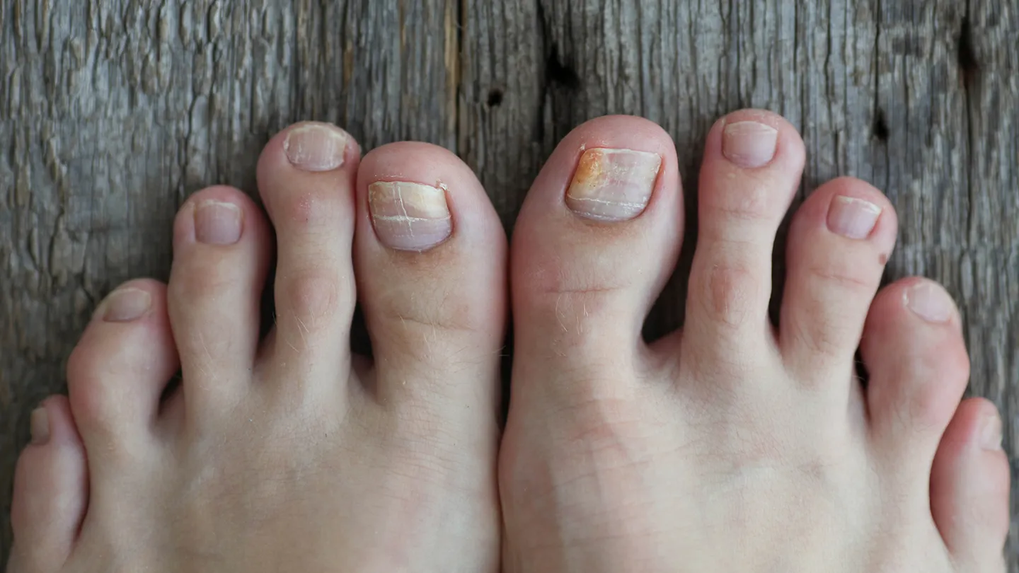 Common-Foot-Problems-10-toenail-fungus-1440x810