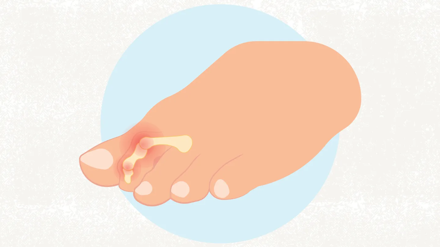 Claw Toes illustration