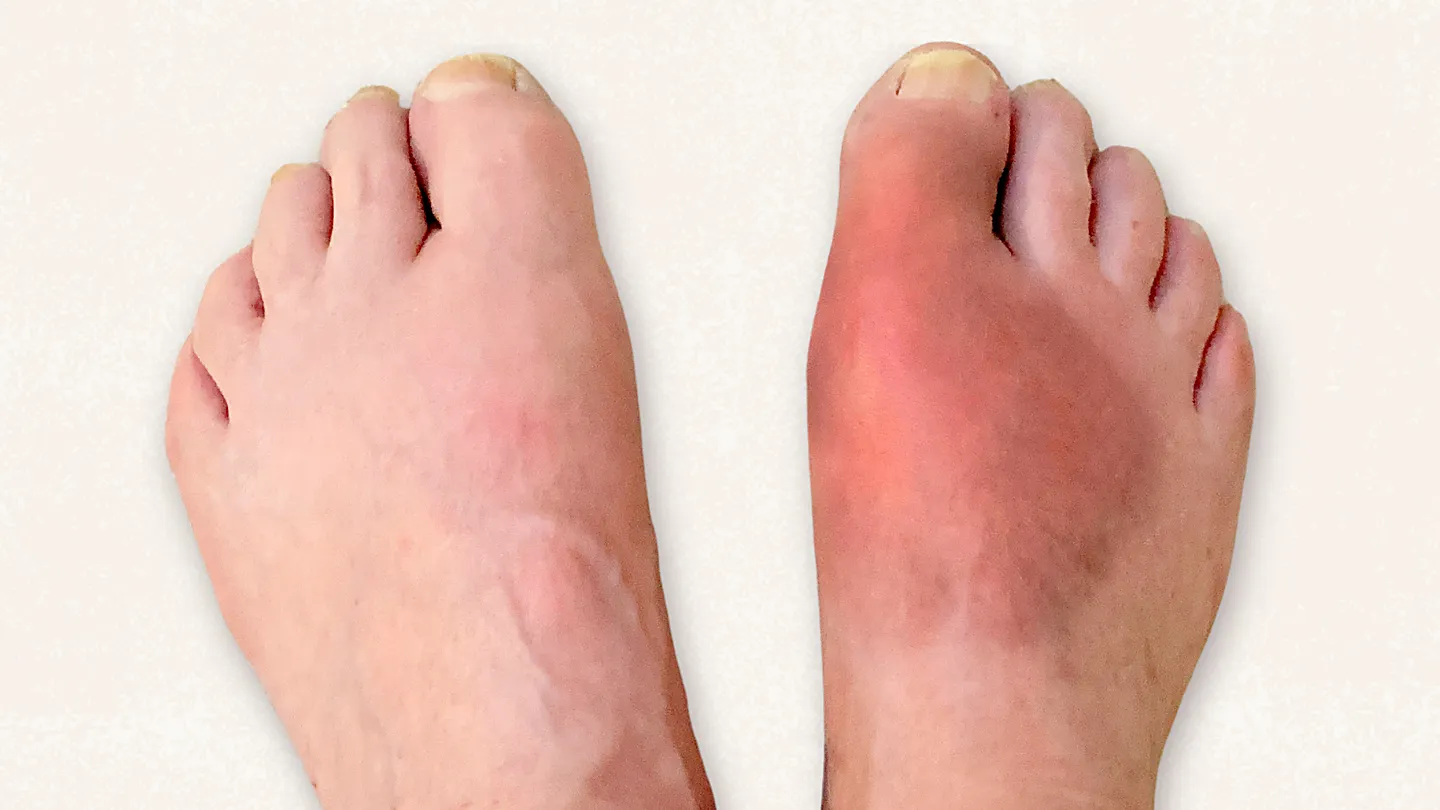 foot with gout