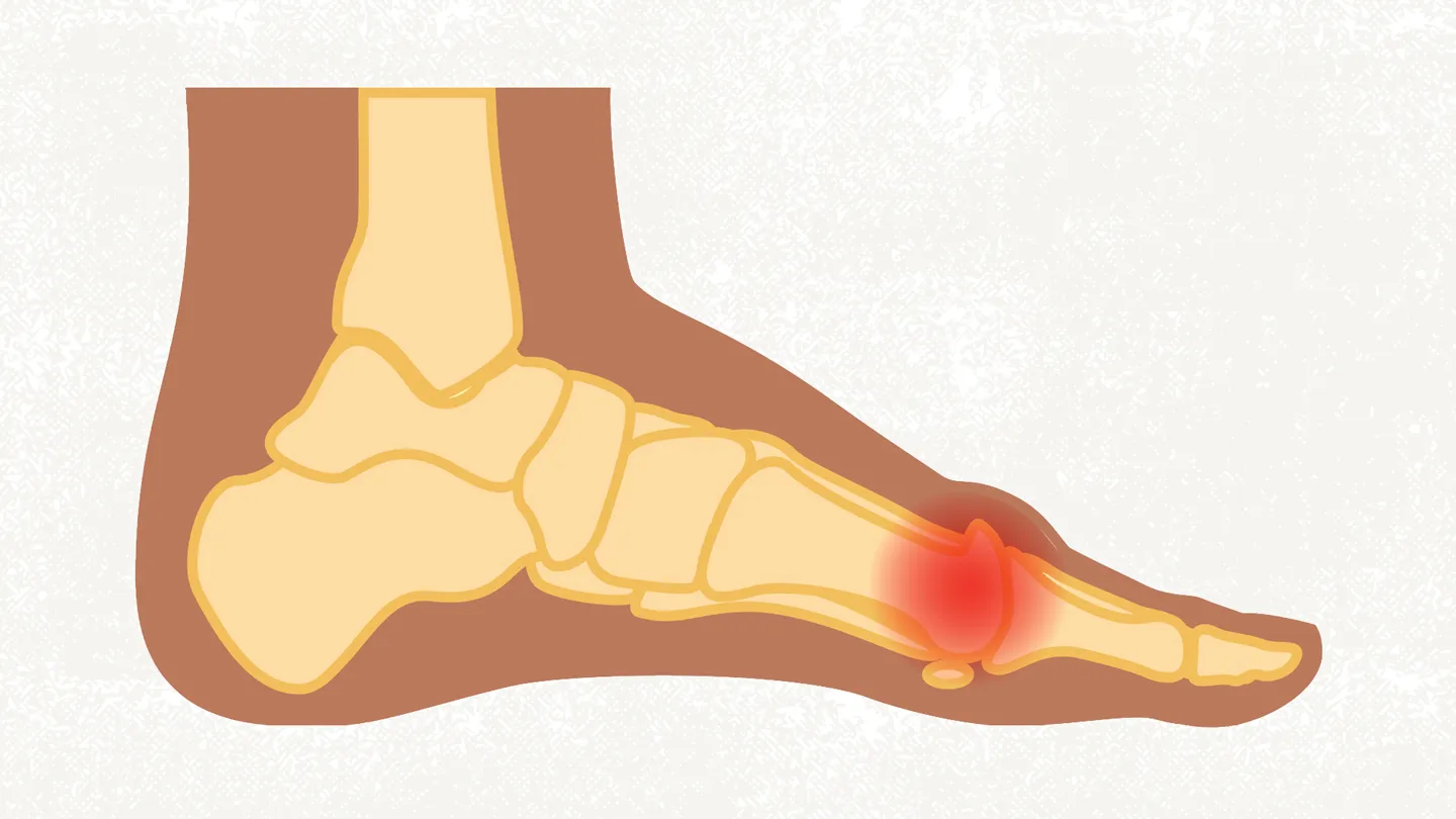 Hallux Rigidus illustration
