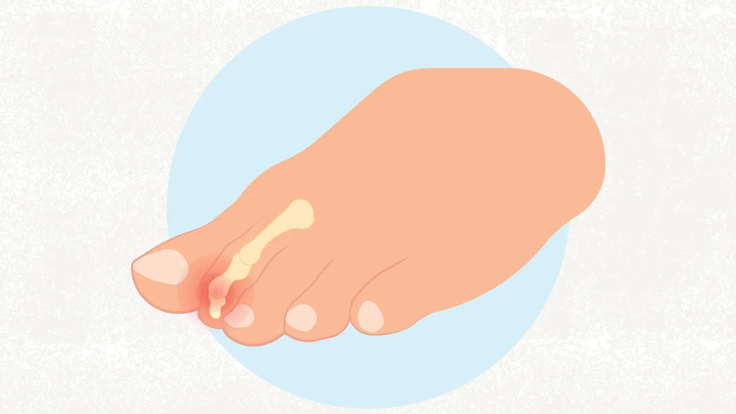 Mallet Toes illustration