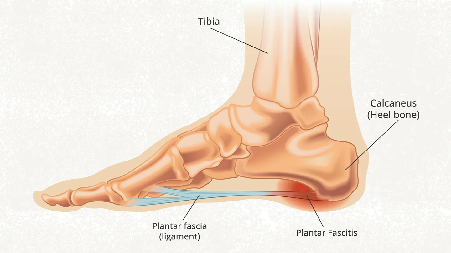 Plantar Fasciitis illustration