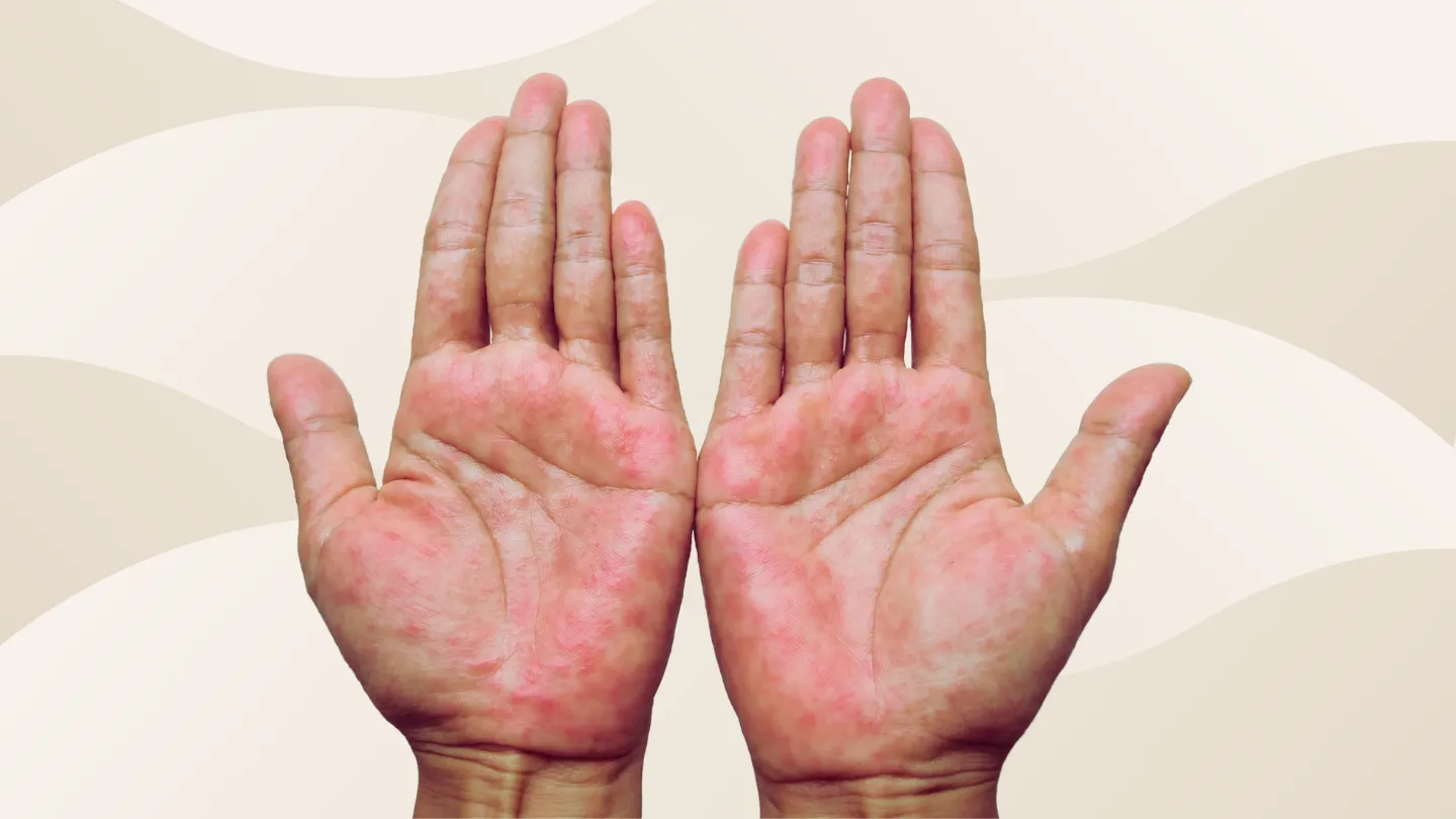 Hands Atopic dermatitis also known as atopic eczema, is a type of inflammation of the skin