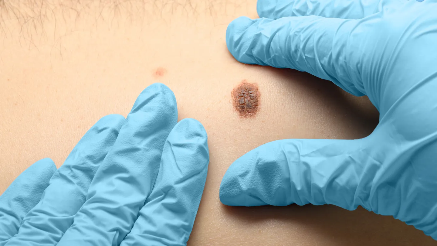dermatologist examining a malignant mole