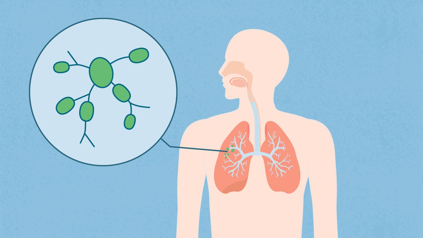 outline of body lungs and lung cancer