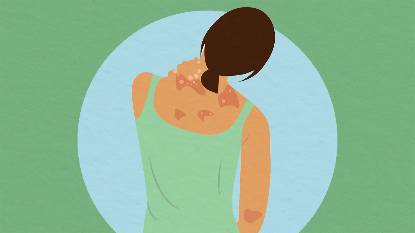 CS-How-to-Manage-Skin-Cracking-and-Bleeding-Psoriasis-1440x810