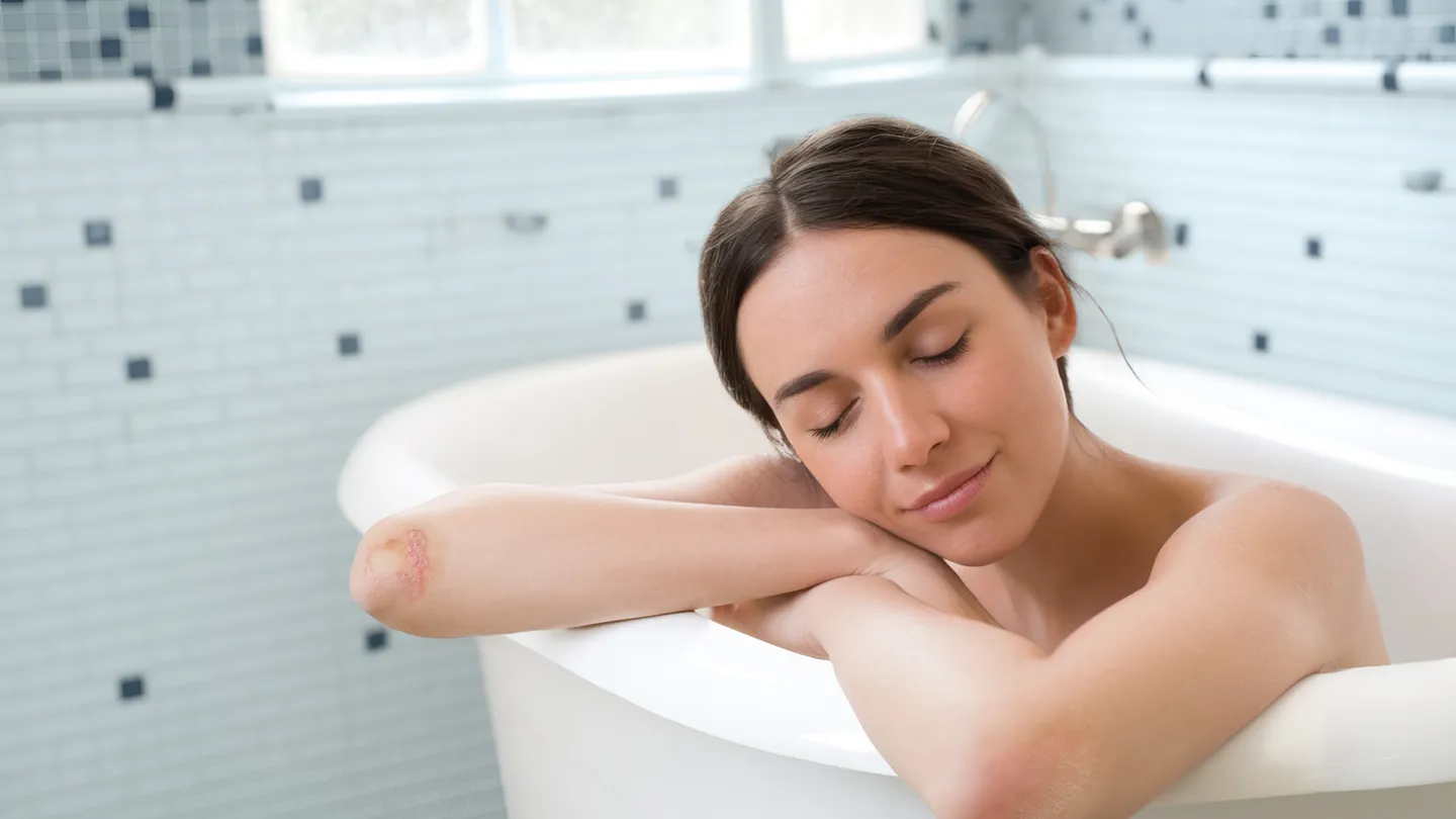 young woman soaking in a bath with psoriasis on elbows
