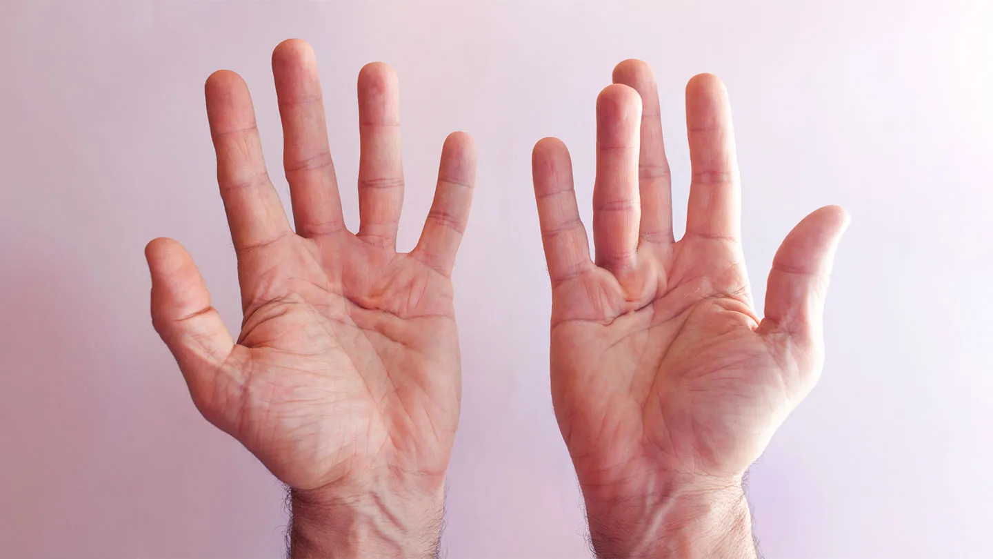 cs-Signs-You-May-Have-Dupuytrens-Contracture-1440x810