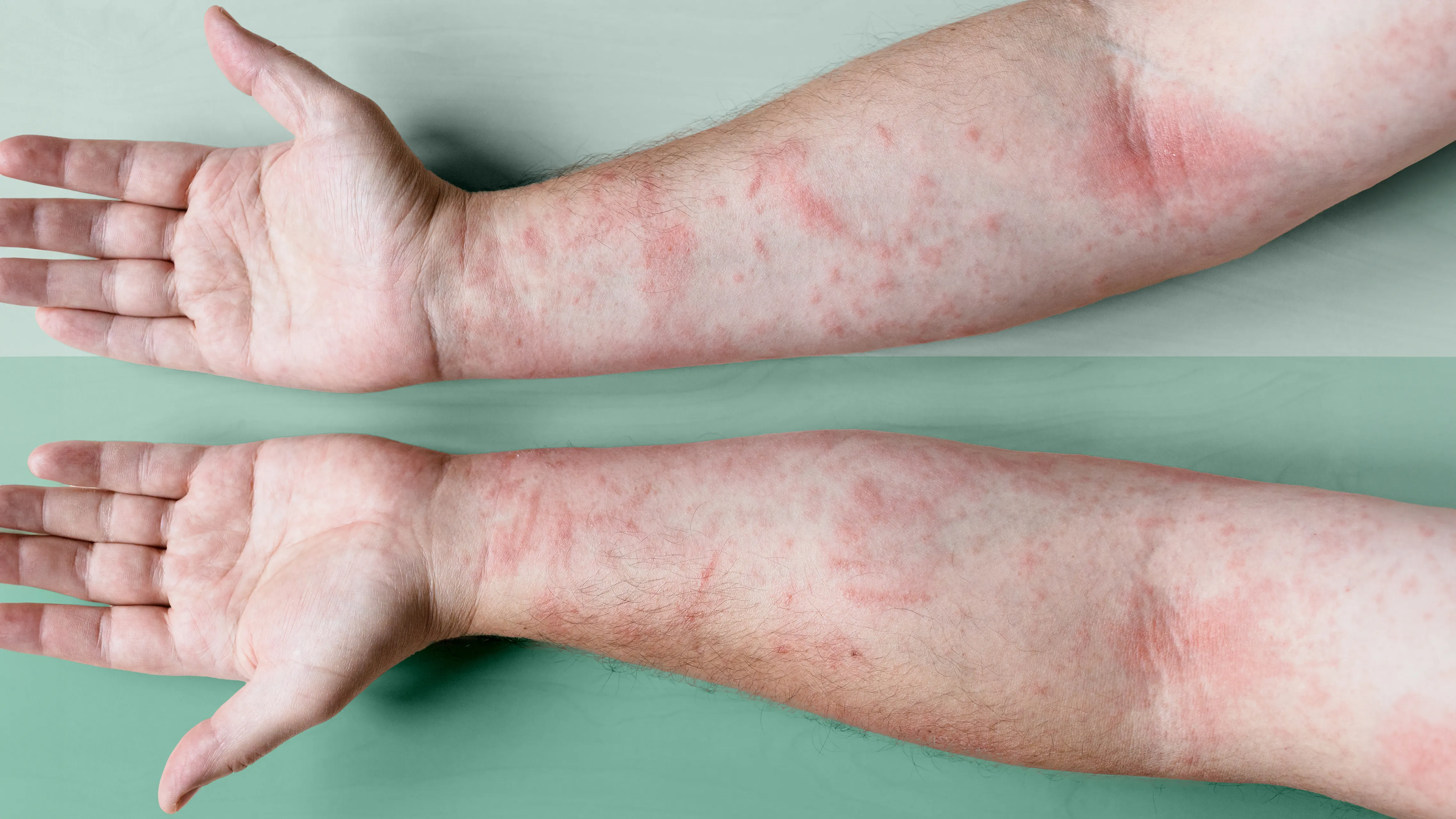 atopic dermatitis