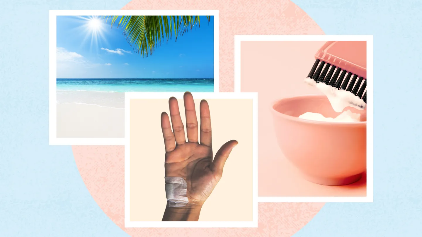 Vitiligo triggers sun exposure, trauma to skin, chemicals hair dye