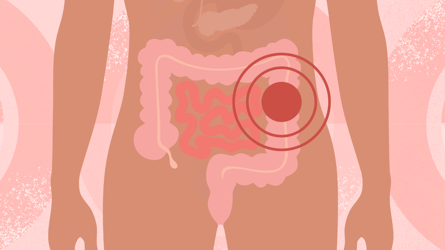 ulcerative colitis medical illustration of intestines