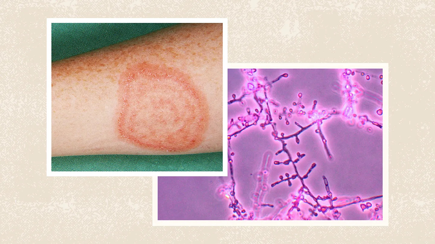 ringworm
