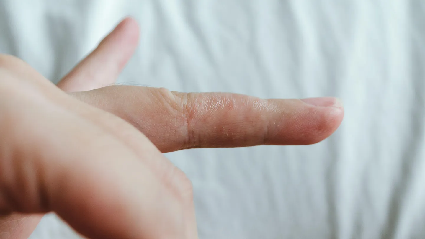 Eczema-Blisters-How-to-Help-Prevent-and-Treat-Them-1440x810