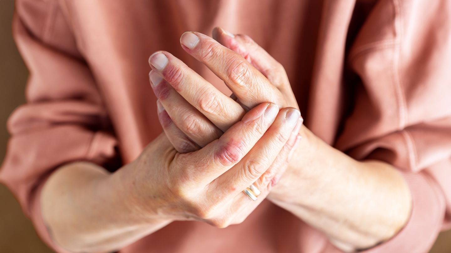 woman with eczema on hands