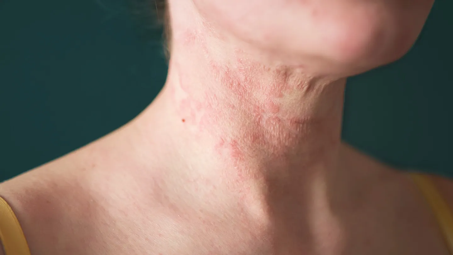 Eczema on neck