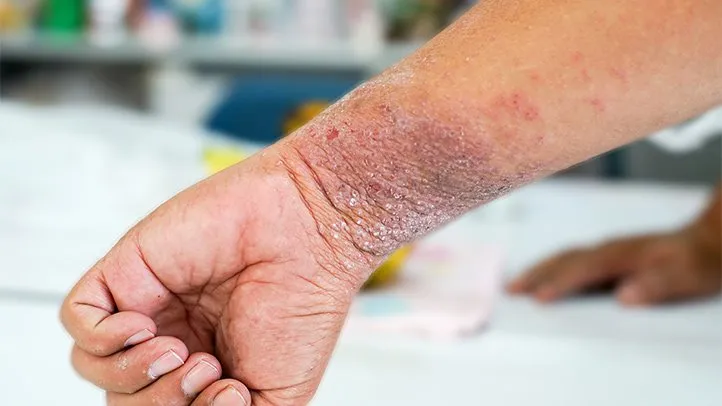 A person's wrist with eczema