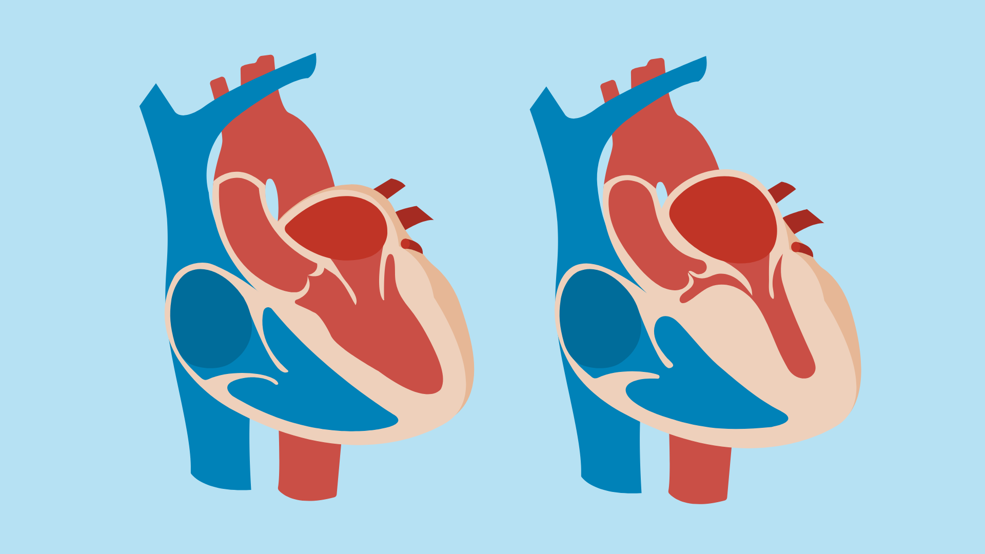 Graphic featuring two hearts. To the left is the normal heart and to the right is the Hypertrophic Cardiomyopathy (HCM) heart.