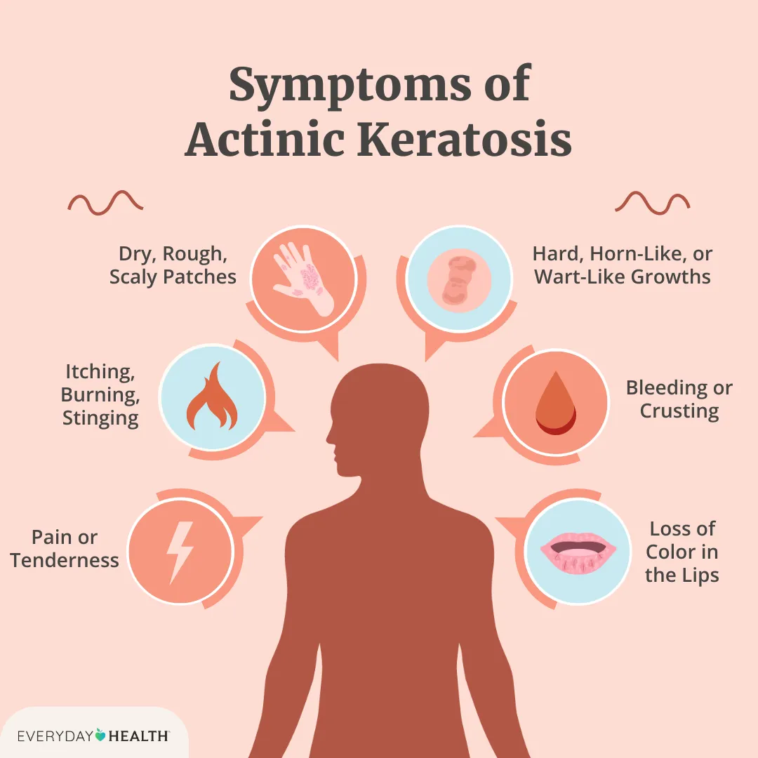 Illustrative graphic titled Symptoms of Actinic Keratosis shows scaly patches, itching/burning, pain or tenderness, loss of color in lips, bleeding, wart like growths. Everyday Health logo
