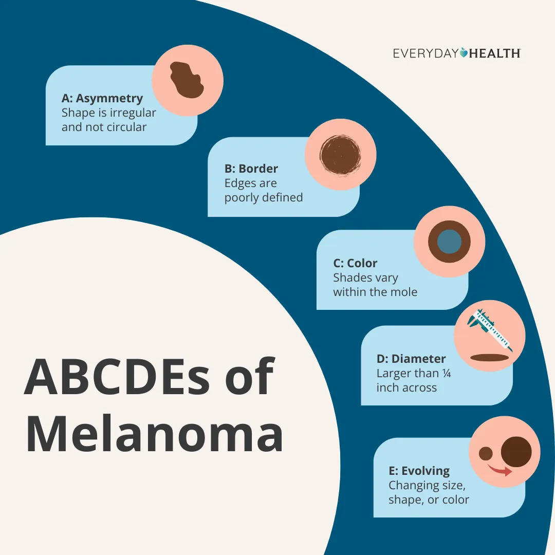 Graphic titled, The ABCDEs of Melanoma, some illustrated points: Shape is irregular and not circular, edges are poorly defined, shades vary within the mole, larger than 1/4 inch across, and changing size, shape, or color. Everyday health logo top right.