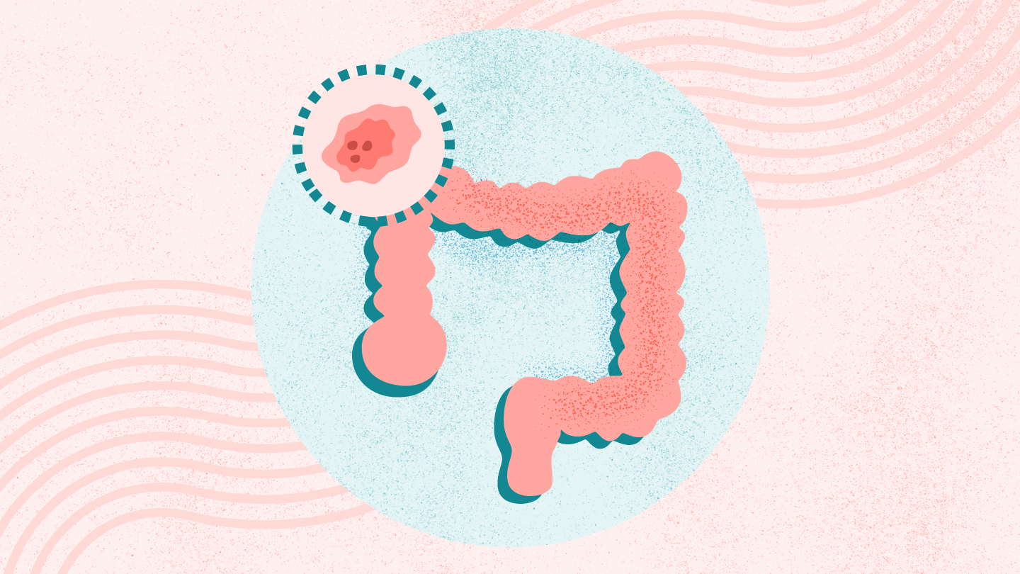 Colon Cancer