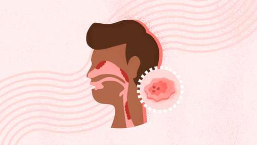 What Is Head and Neck Cancer? Causes, Symptoms, Diagnosis, Treatment, and Prevention