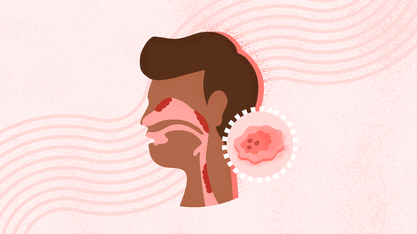 Head & Neck Cancer