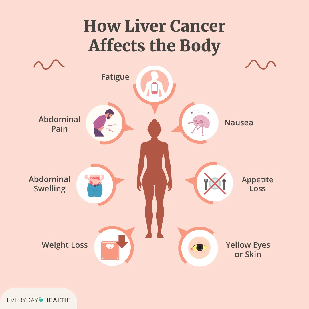 Illustrative graphic titled How Liver Cancer Affects the Body shows fatigue, abdominal pain, abdominal swelling, weight loss, yellow eyes or skin, appetite loss, and nausea. Everyday Health at bottom left