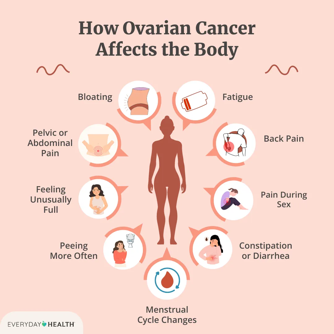 Illustrative graphic titled How Ovarian Cancer Affects the Body shows bloating, pelvic pain, feeling full, peeing more, menstrual changes, diarrhea, pain during sex, back pain and fatigue. Everyday Health logo at bottom left