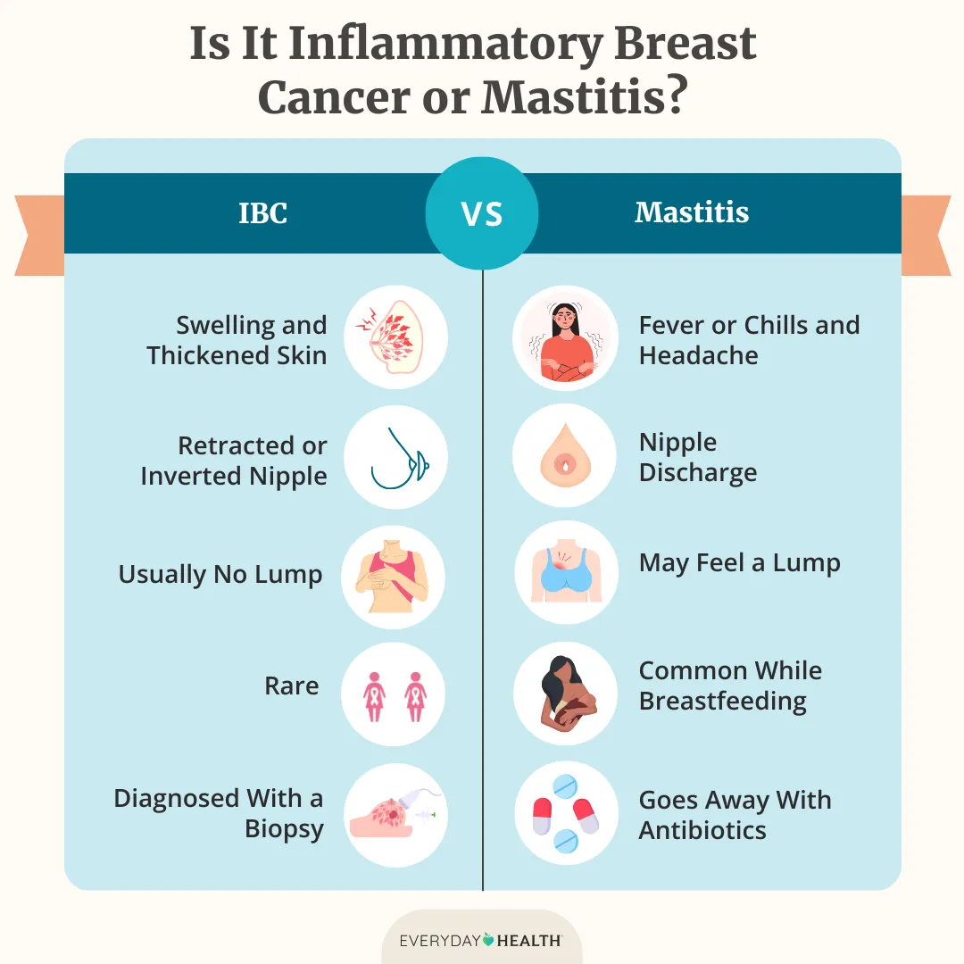 Illustrative graphic titled Inflammatory Breast Cancer or Mastitis shows IBC: Swelling, inverted nipple, no lump, rare, diagnosed with a biopsy. Mastitis: fever/chills, nipple discharge, may feel a lump, common with breastfeeding and antibiotics