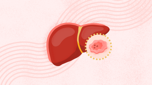 What Is Liver Cancer?
