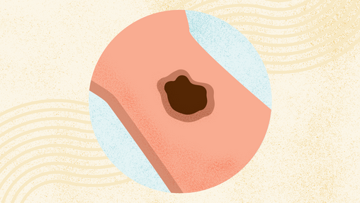 What Is Melanoma? Symptoms, Causes, Diagnosis, Treatment, and Prevention