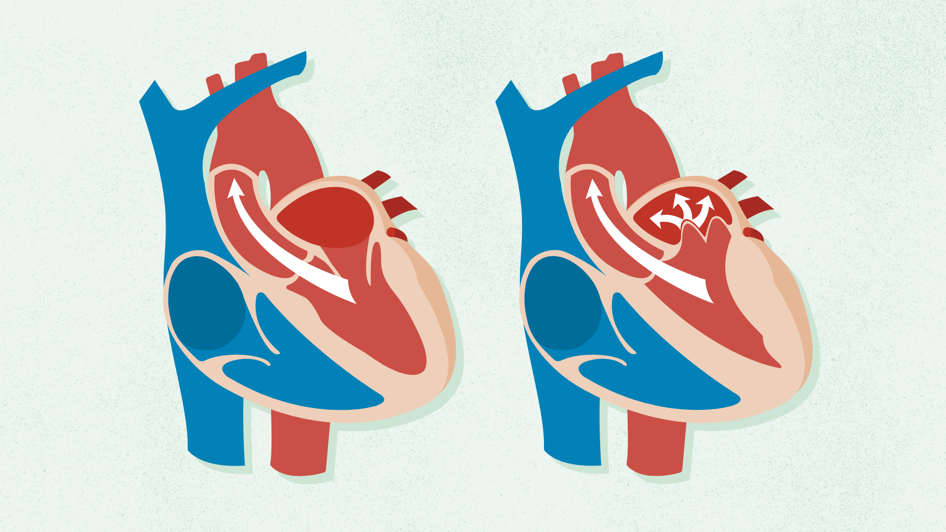 Graphic featuring two hearts. To the left is the normal heart and to the right is the Mitral Valve Prolapse heart.