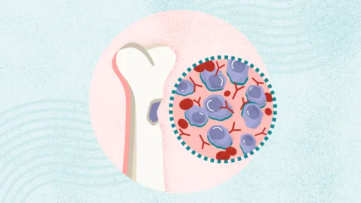 What Is Multiple Myeloma? Symptoms, Causes, Diagnosis, Treatment, and Prevention