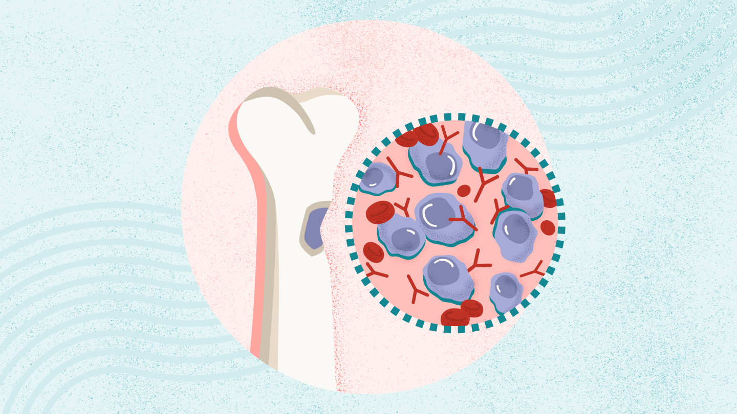 Multiple Myeloma